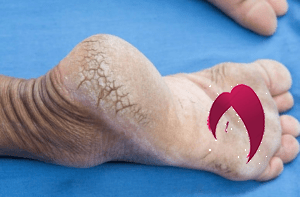 Sécheresse des talons