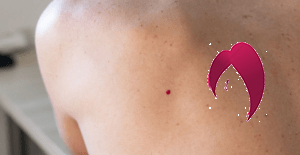 petit point rouge sur la peau