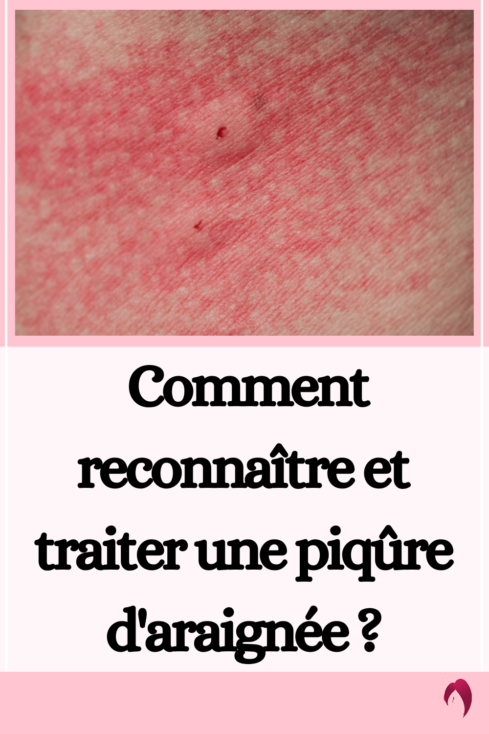 Comment reconnaître et traiter une piqûre d