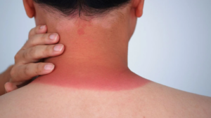 Soulager un coup de soleil