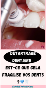 Détartrage dentaire : Est-ce que cela provoque des dents fragiles