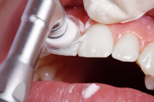 Détartrage dentaire : Est-ce que cela provoque des dents fragiles