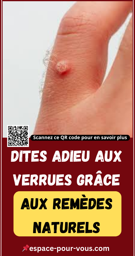 Dites adieu aux verrues