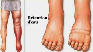 rétention d'eau