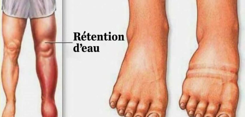 rétention d'eau