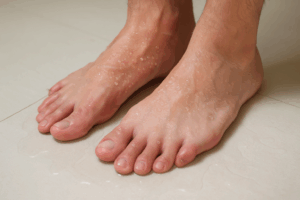 Transpiration excessive du pied